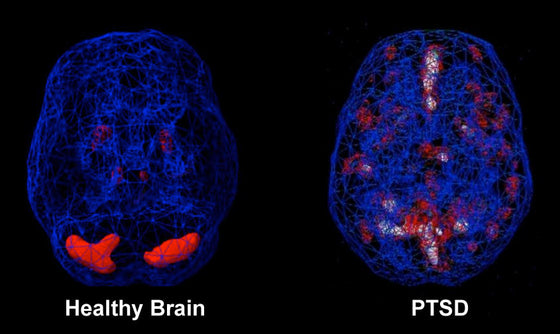 5 Freedom-From-PTSD Techniques Your Medical Doctor May Not Have Mentioned